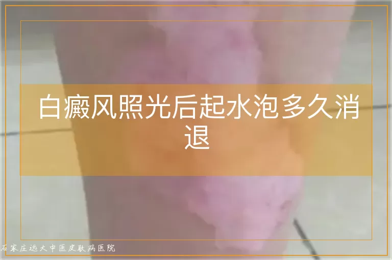 白癜风照光后起水泡多久消退