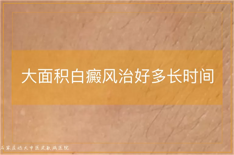 大面积白癜风治好多长时间