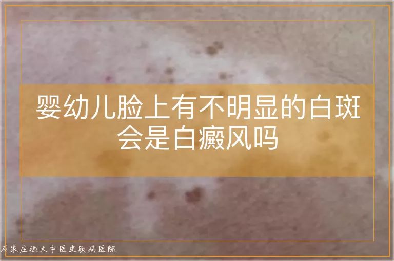 婴幼儿脸上有不明显的白斑会是白癜风吗
