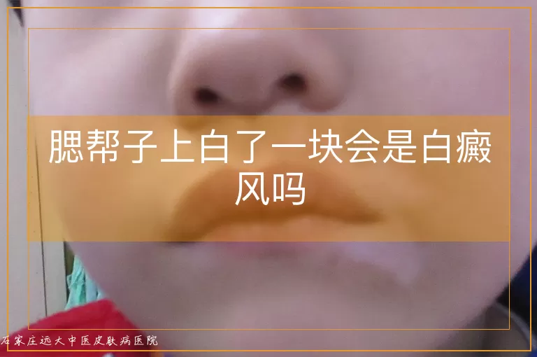 腮帮子上白了一块会是白癜风吗