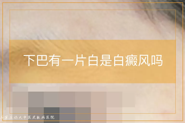 下巴有一片白是白癜风吗