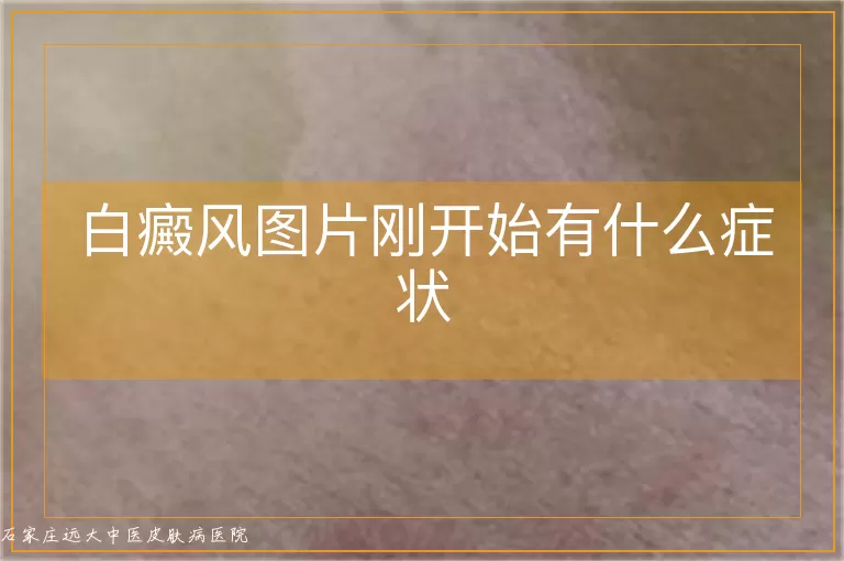 白癜风图片刚开始有什么症状