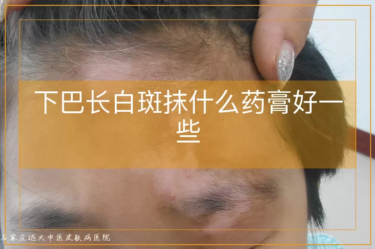 下巴长白斑抹什么药膏好一些