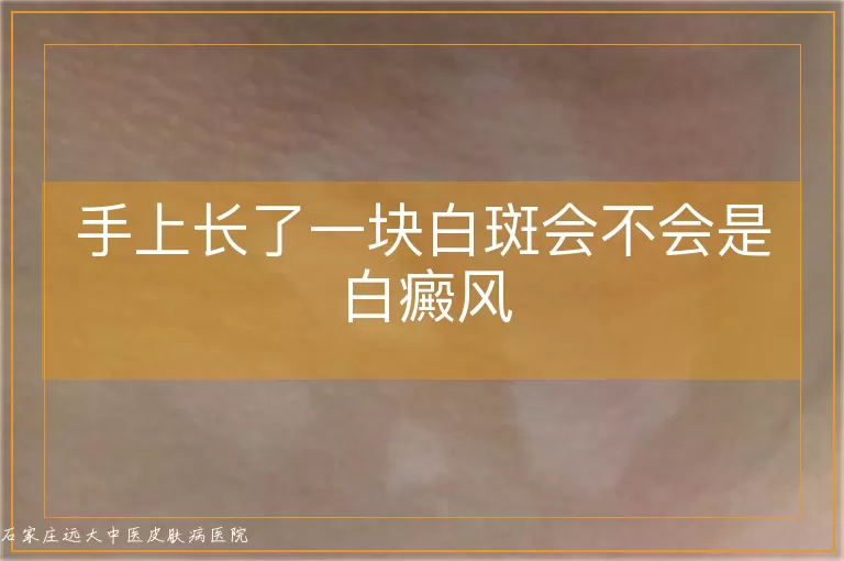 手上长了一块白斑会不会是白癜风