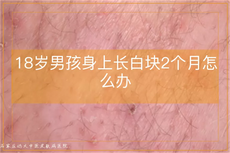 18岁男孩身上长白块2个月怎么办