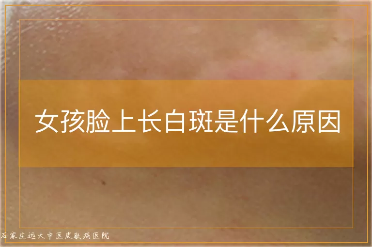 女孩脸上长白斑是什么原因