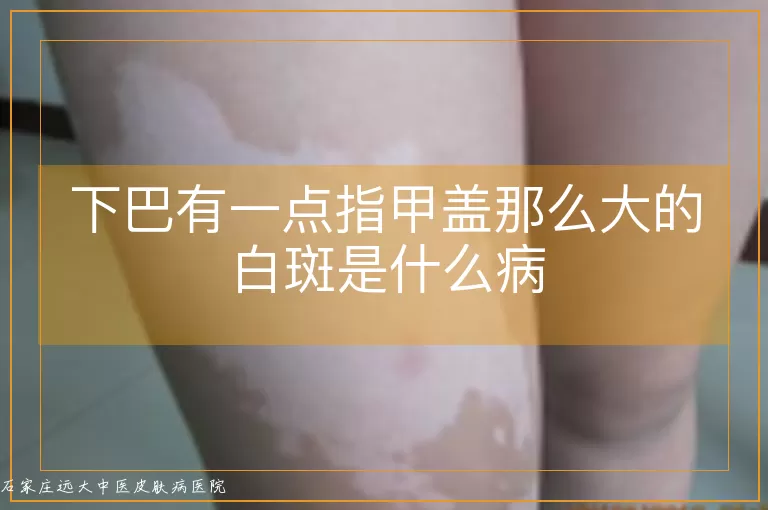 下巴有一点指甲盖那么大的白斑是什么病