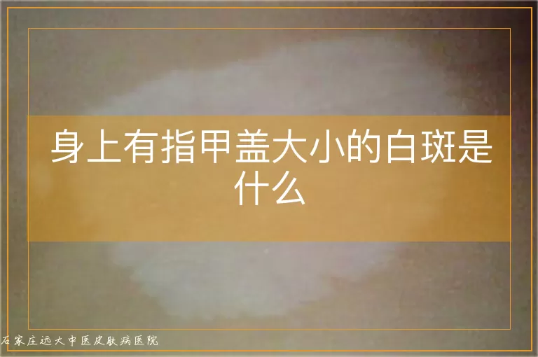 身上有指甲盖大小的白斑是什么