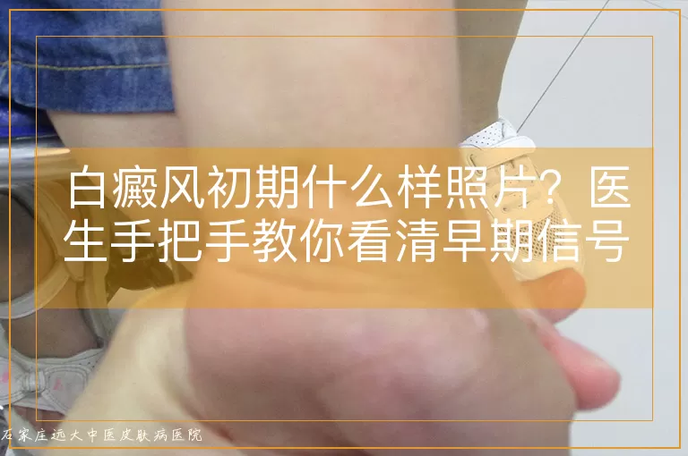 白癜风初期什么样照片？医生手把手教你看清早期信号