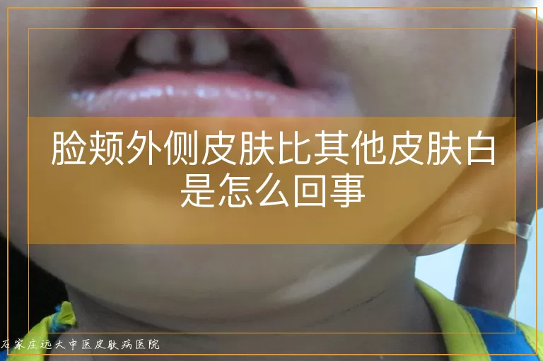 脸颊外侧皮肤比其他皮肤白是怎么回事