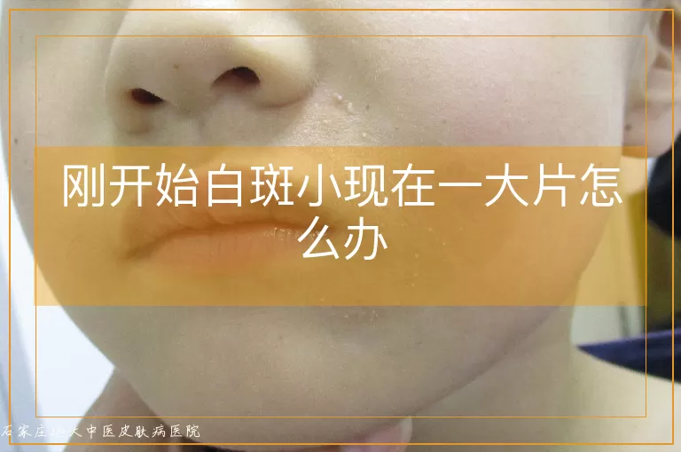 刚开始白斑小现在一大片怎么办