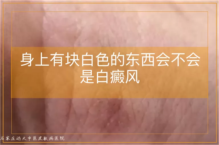 身上有块白色的东西会不会是白癜风