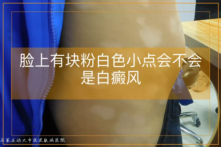 脸上有块粉白色小点会不会是白癜风