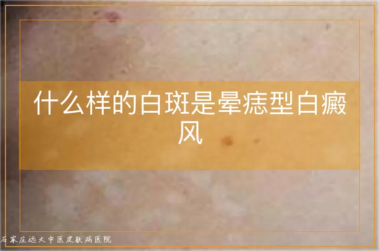 什么样的白斑是晕痣型白癜风