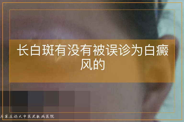 长白斑有没有被误诊为白癜风的