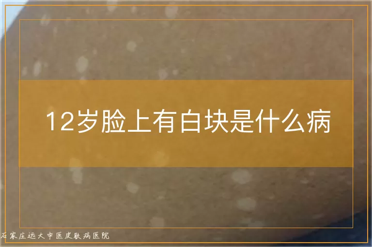 12岁脸上有白块是什么病