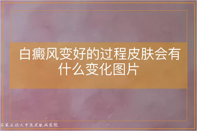 白癜风变好的过程皮肤会有什么变化图片