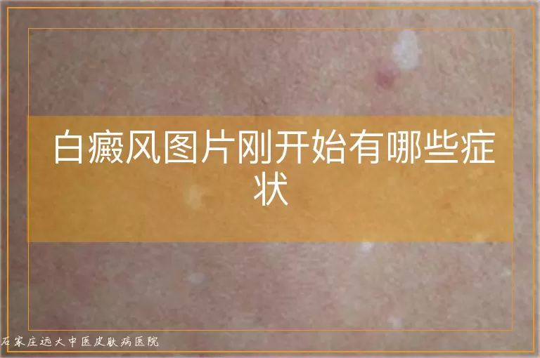 白癜风图片刚开始有哪些症状