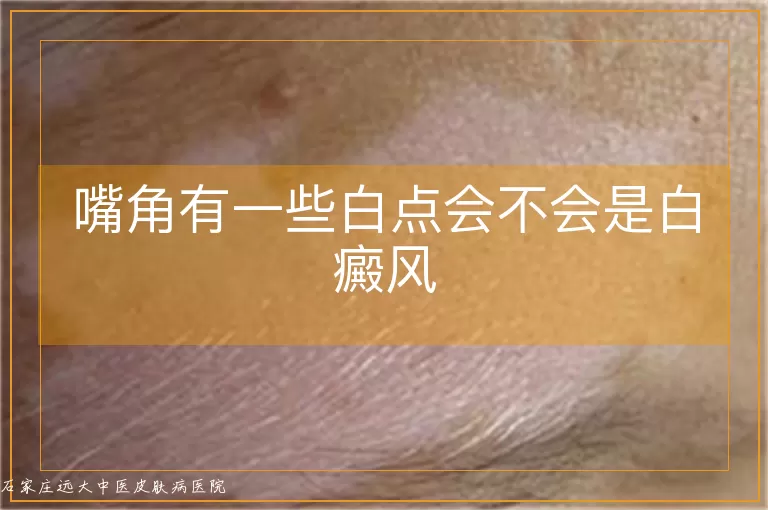 嘴角有一些白点会不会是白癜风