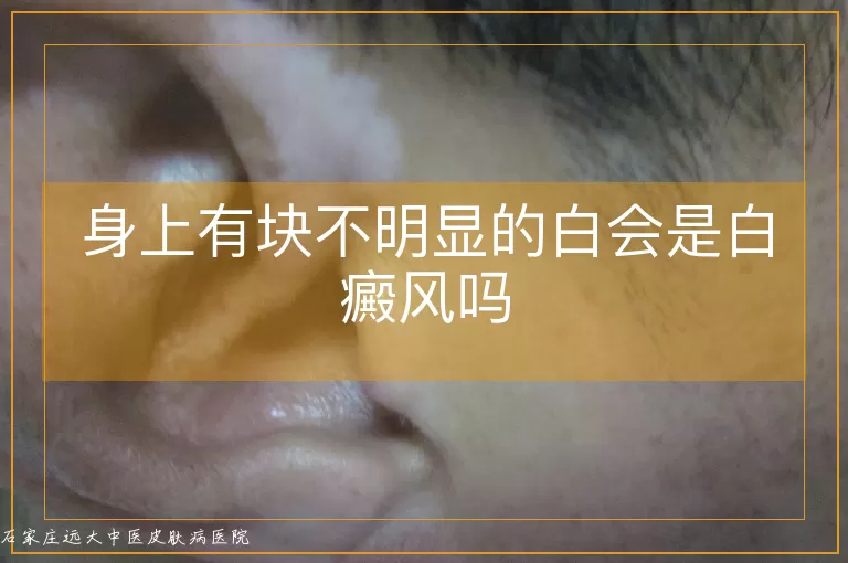 身上有块不明显的白会是白癜风吗