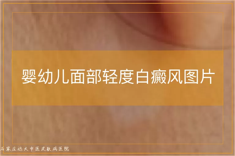 婴幼儿面部轻度白癜风图片