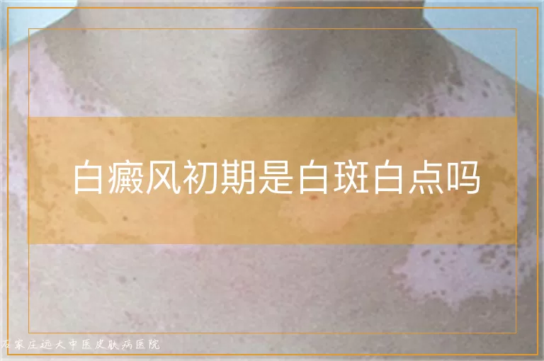 白癜风初期是白斑白点吗