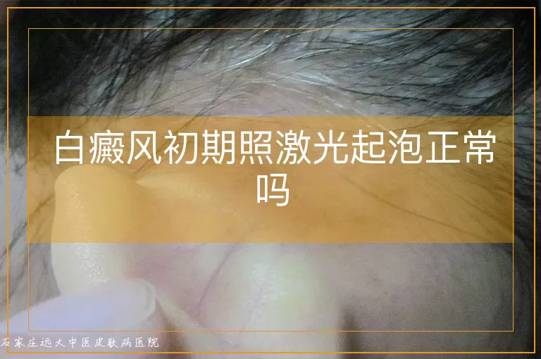 白癜风初期照激光起泡正常吗