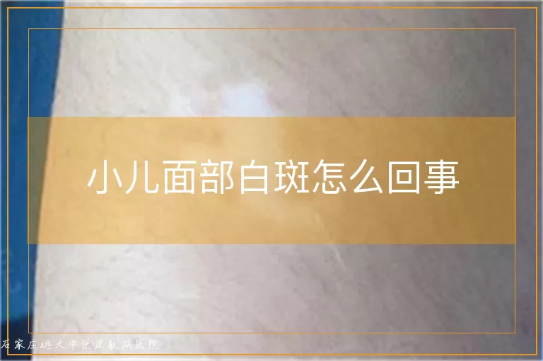 小儿面部白斑怎么回事
