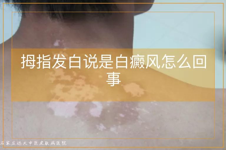 拇指发白说是白癜风怎么回事