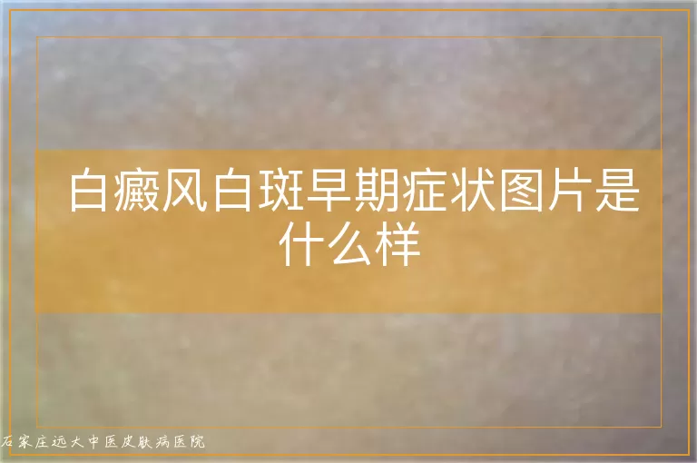 白癜风白斑早期症状图片是什么样