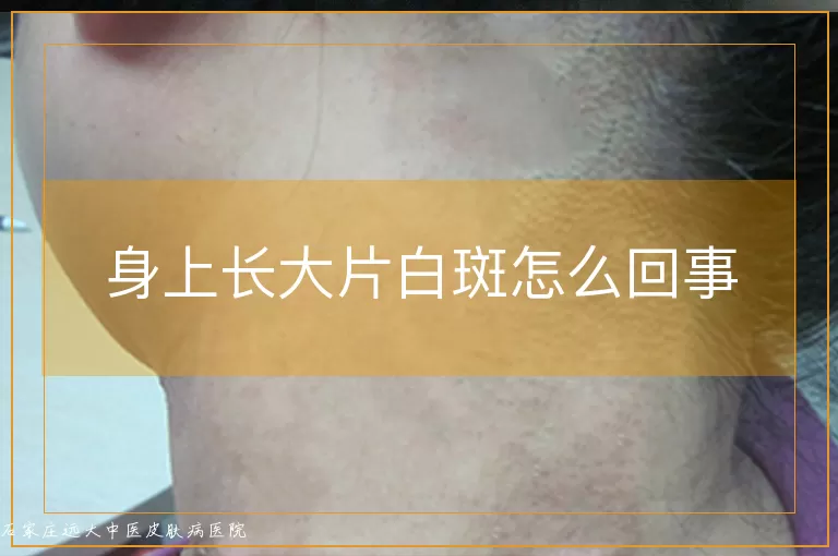 身上长大片白斑怎么回事