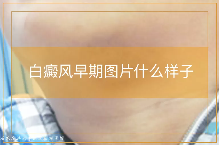 白癜风早期图片什么样子