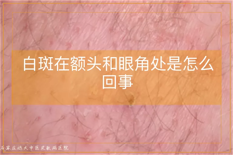 白斑在额头和眼角处是怎么回事