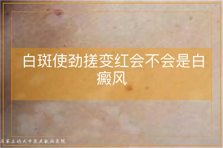 白斑使劲搓变红会不会是白癜风