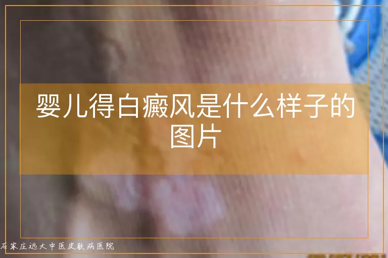 婴儿得白癜风是什么样子的图片