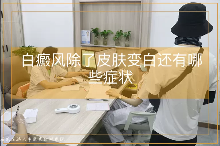 白癜风除了皮肤变白还有哪些症状