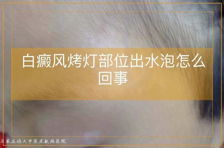 白癜风烤灯部位出水泡怎么回事