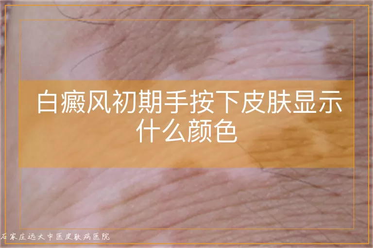 白癜风初期手按下皮肤显示什么颜色