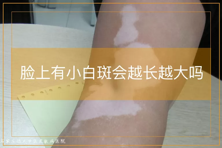 脸上有小白斑会越长越大吗