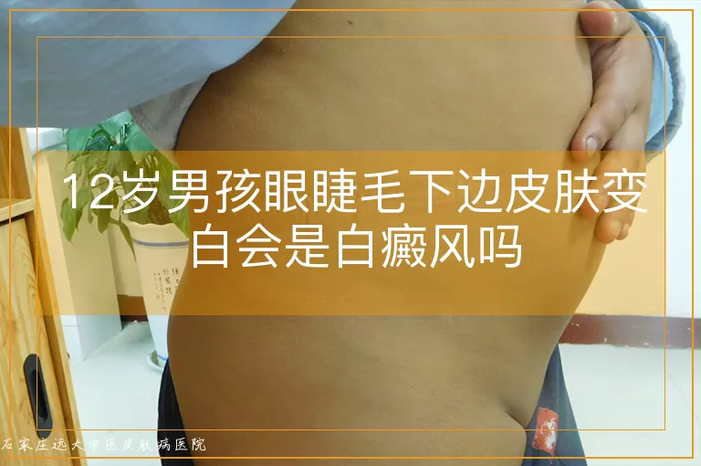 12岁男孩眼睫毛下边皮肤变白会是白癜风吗
