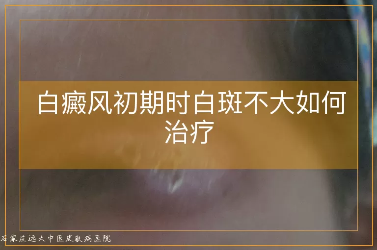 白癜风初期时白斑不大如何治疗