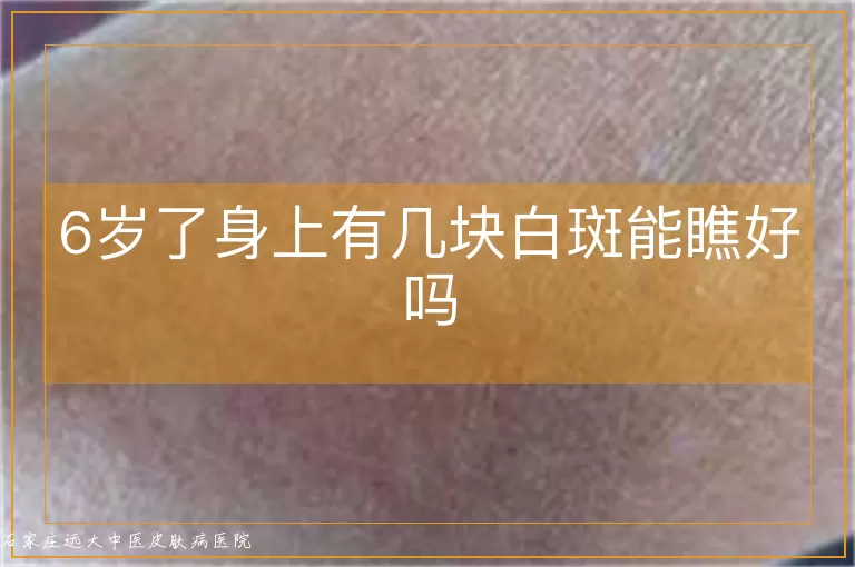 6岁了身上有几块白斑能瞧好吗