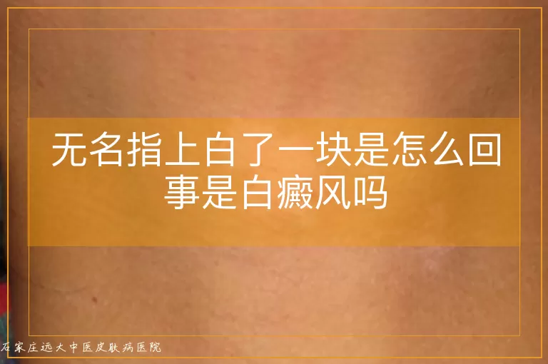 无名指上白了一块是怎么回事是白癜风吗