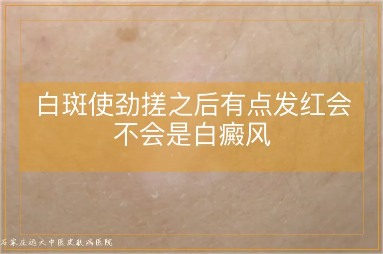 白斑使劲搓之后有点发红会不会是白癜风