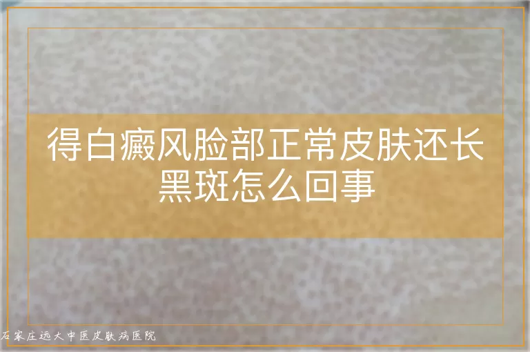 得白癜风脸部正常皮肤还长黑斑怎么回事