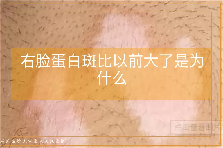 右脸蛋白斑比以前大了是为什么