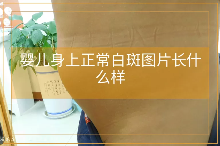 婴儿身上正常白斑图片长什么样
