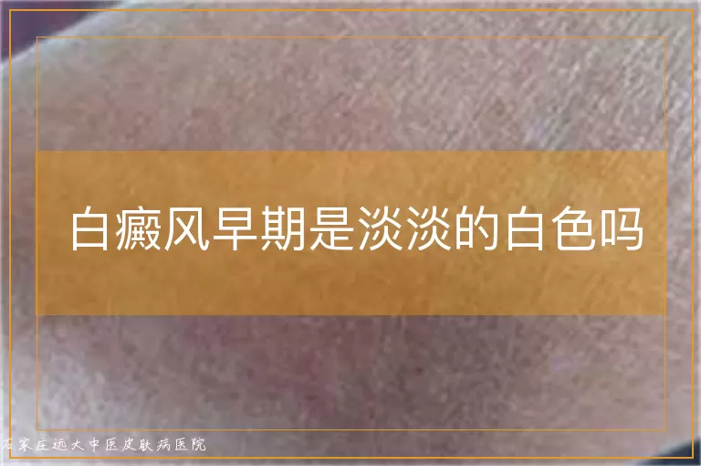 白癜风早期是淡淡的白色吗