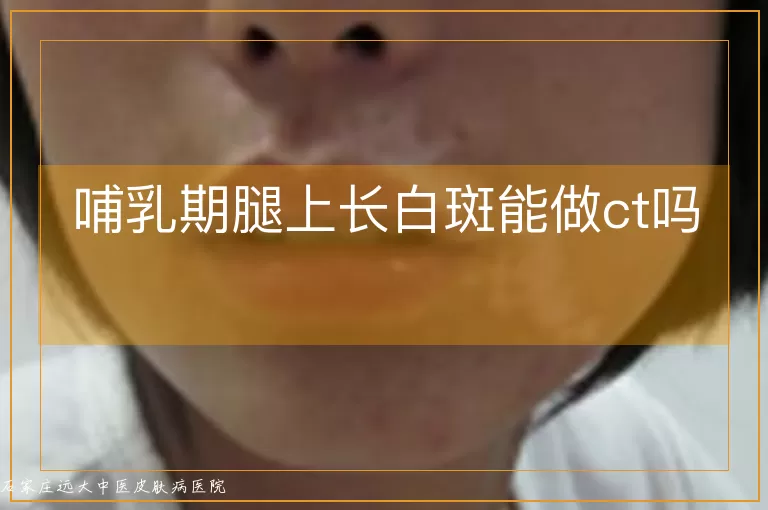哺乳期腿上长白斑能做ct吗