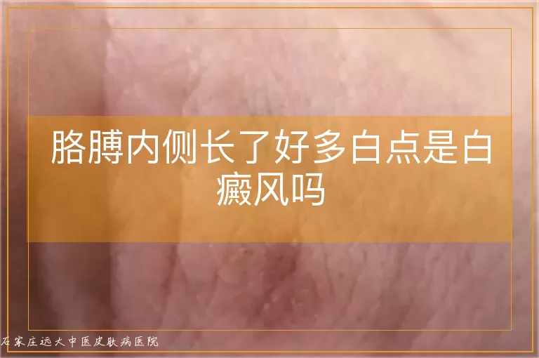 胳膊内侧长了好多白点是白癜风吗